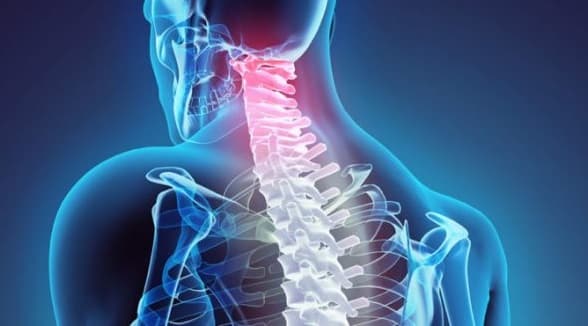 دیسک کمر و گردن، دیسک گردن